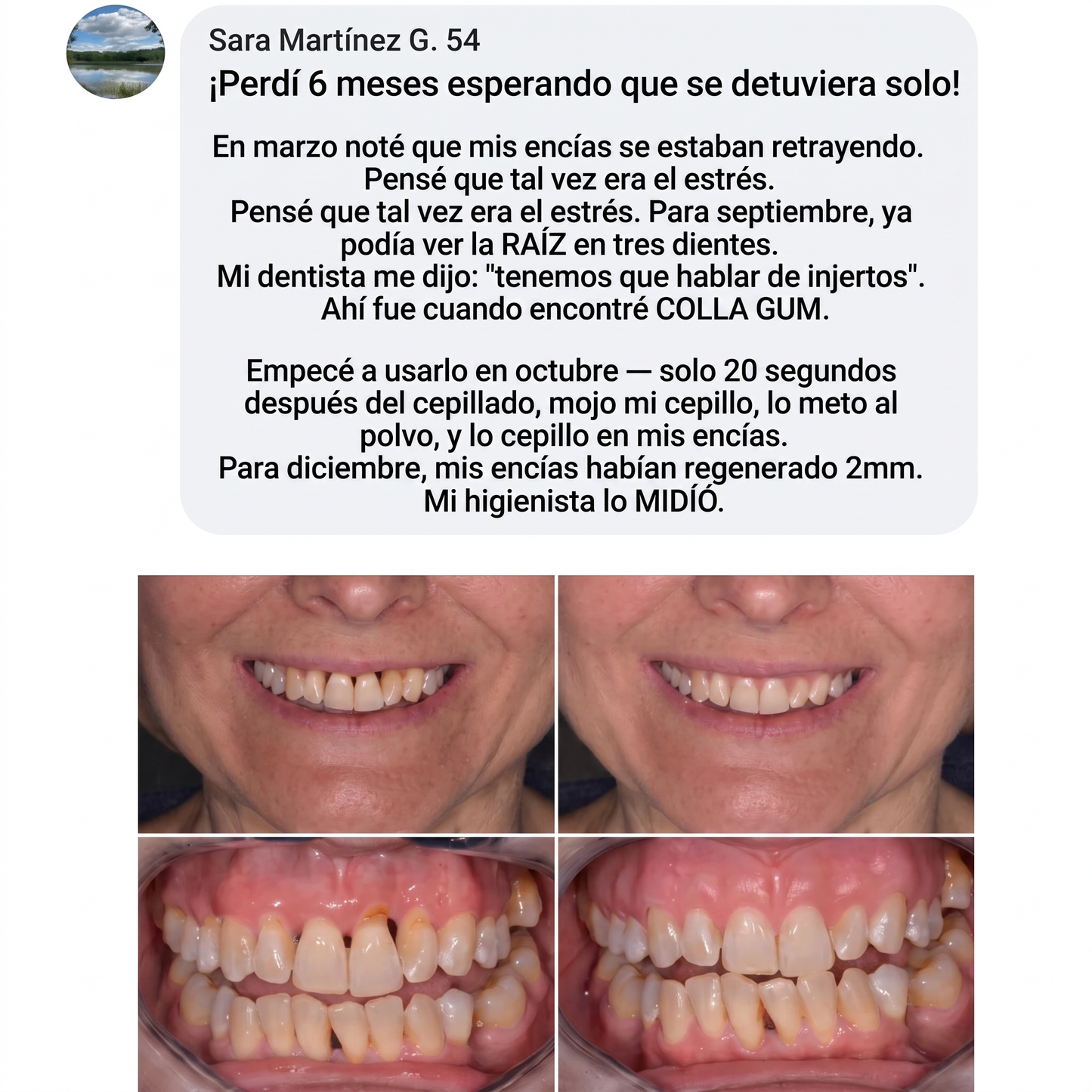 Colla Gum® Polvo de Colágeno para Encías