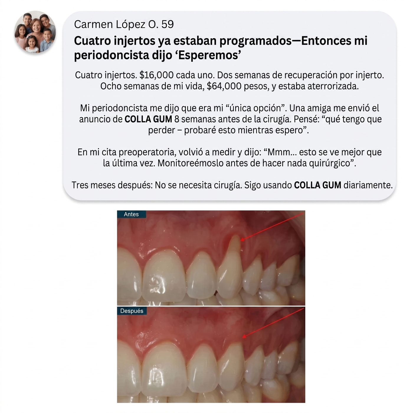 Colla Gum® Polvo de Colágeno para Encías