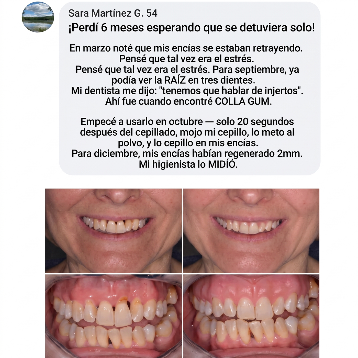 Colla Gum® Polvo de Colágeno para Encías